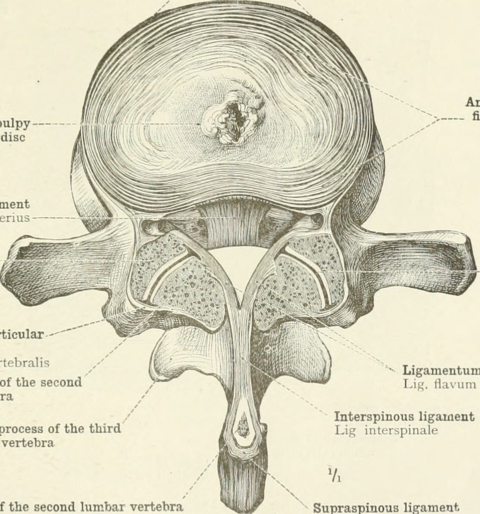 Can Nanofiber Technology Reduce Re-Herniation Rates after Microdiscectomy? Analyzing a Recent Preclinical Study of Annulus Repair