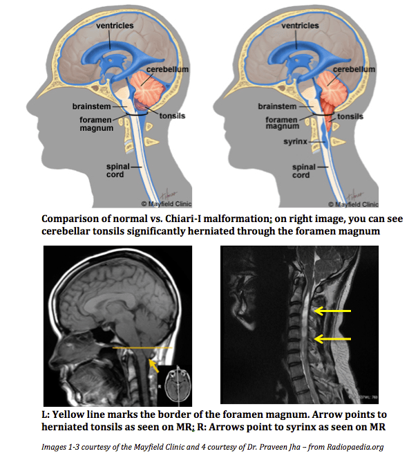 Predicting Surgical Outcomes Using MR Imaging in Chiari-I Malformation Patients