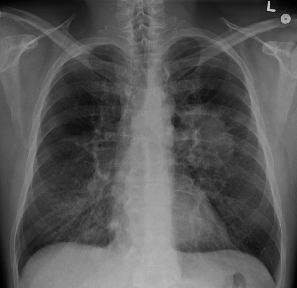 Lifting the Veil: Dissecting Lung Cancer Risks Among Asian American Female Nonsmokers