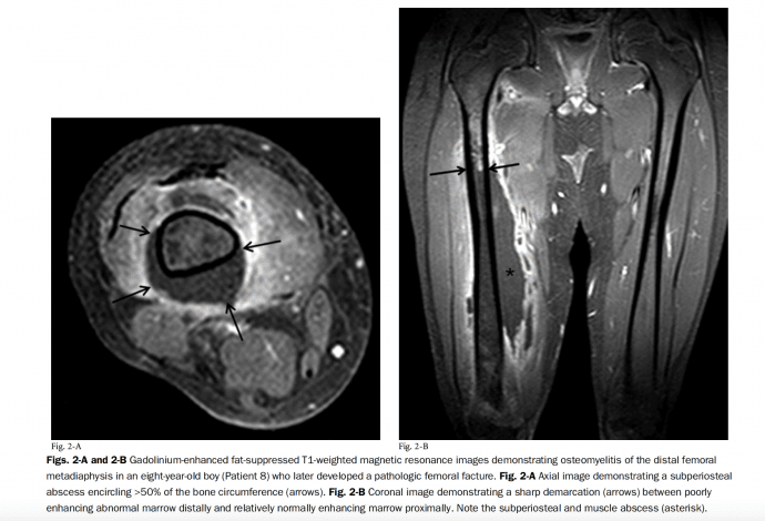 Comparative Mid-Term Outcomes of Pediatric Hematogenous Methicillin-Resistant Staphylococcus aureus and Methicillin-Susceptible Staphylococcus aureus Osteomyelitis